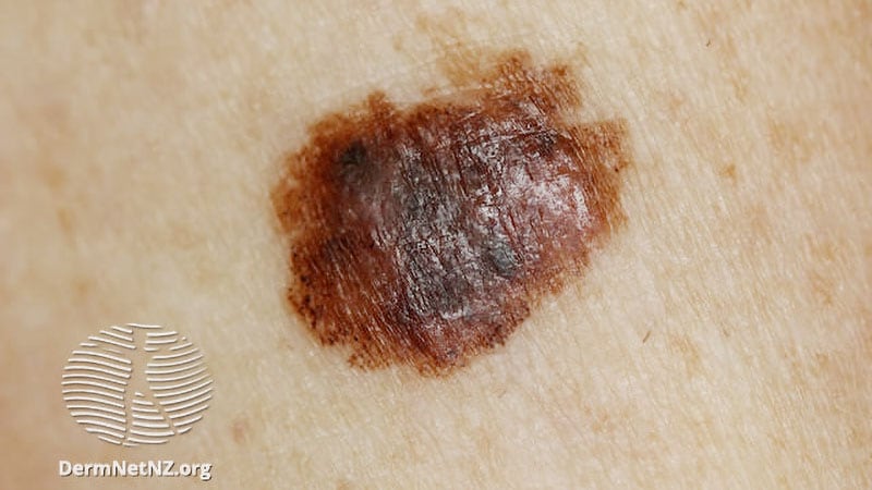 Neoadj T-VEC May Improve Survival in Resectable Melanoma