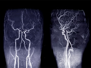 Endovascular Benefit Finally Confirmed for Basilar Artery Stroke