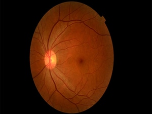 Methotrexate Could Reduce the Risk for Retinal Redetachment