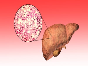 Fatty Liver Disease Drives Rise in Liver Cancer Deaths