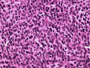 New CAR-T Therapy Elicits Strong Response in Multiple Myeloma