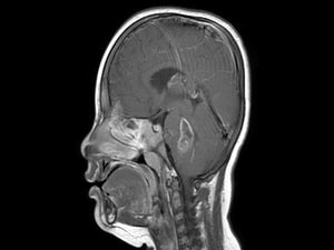 Targeted Therapy an 'Important Advance' in Childhood Glioma